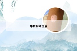 牛皮癣红斑点