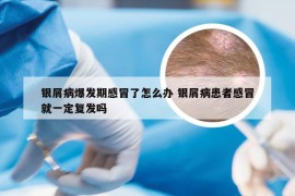 银屑病爆发期感冒了怎么办 银屑病患者感冒就一定复发吗