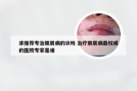 求推荐专治银屑病的诊所 治疗银屑病最权威的医院专家是谁