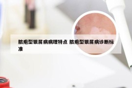 脓疱型银屑病病理特点 脓疱型银屑病诊断标准