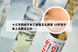 十几岁的孩子长了癣是怎么回事 10岁孩子身上长癣怎么办