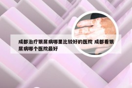 成都治疗银屑病哪里比较好的医院 成都看银屑病哪个医院最好