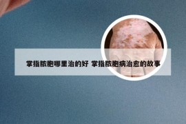 掌指脓胞哪里治的好 掌指脓胞病治愈的故事