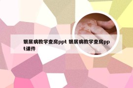 银屑病教学查房ppt 银屑病教学查房ppt课件