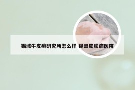 锡城牛皮癣研究所怎么样 锡盟皮肤病医院