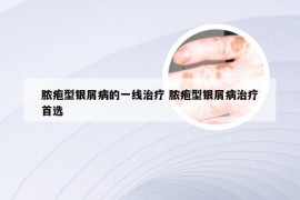 脓疱型银屑病的一线治疗 脓疱型银屑病治疗首选