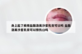 身上起了癣用盐酸洛美沙星乳膏可以吗 盐酸洛美沙星乳膏可以擦伤口吗