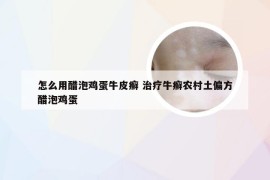 怎么用醋泡鸡蛋牛皮癣 治疗牛癣农村土偏方醋泡鸡蛋