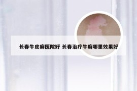 长春牛皮癣医院好 长春治疗牛癣哪里效果好