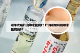 看牛皮癣广州哪家医院好 广州看银屑病哪家医院最好