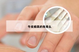 牛皮癣真的有用么