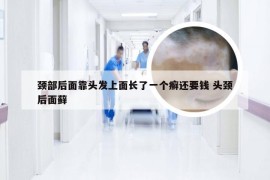 颈部后面靠头发上面长了一个癣还要钱 头颈后面藓