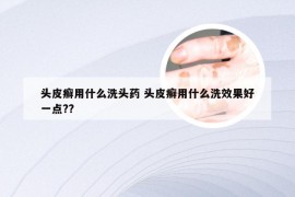 头皮癣用什么洗头药 头皮癣用什么洗效果好一点??