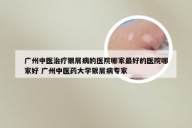 广州中医治疗银屑病的医院哪家最好的医院哪家好 广州中医药大学银屑病专家