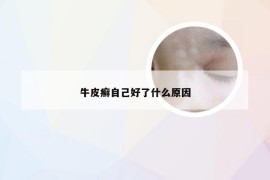 牛皮癣自己好了什么原因