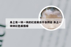 身上有一块一块的红皮癣会不会传染 身上一块块红色癣很痒