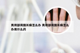 男阴部周围长癣怎么办 男阴部周围长癣怎么办用什么药