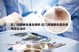 肛门周围都白是白斑吗 肛门周围都白是白斑吗怎么治疗