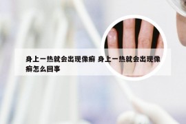 身上一热就会出现像癣 身上一热就会出现像癣怎么回事