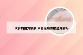 大蒜的偏方银病 大蒜治癣除根是真的吗