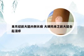 来月经前大腿内侧长癣 大姨妈来之前大腿会起湿疹