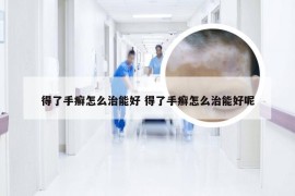 得了手癣怎么治能好 得了手癣怎么治能好呢