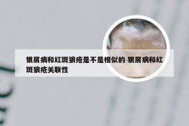 银屑病和红斑狼疮是不是相似的 银屑病和红斑狼疮关联性