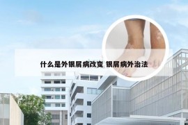 什么是外银屑病改变 银屑病外治法