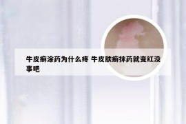 牛皮癣涂药为什么疼 牛皮肤癣抹药就变红没事吧