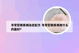 寻常型银屑病治愈配方 寻常型银屑病用什么药最好?