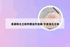 青黛和凡士林外敷治牛皮癣 牛皮涂凡士林