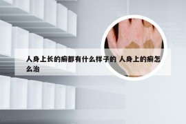 人身上长的癣都有什么样子的 人身上的癣怎么治