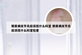 银屑病关节炎应该挂什么科室 银屑病关节炎应该挂什么科室检查