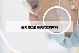 癣类皮肤病 癣类皮肤病辨别