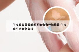 牛皮廨如果长时间不治会有什lc结果 牛皮廨不治会怎么样