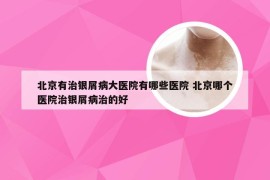 北京有治银屑病大医院有哪些医院 北京哪个医院治银屑病治的好