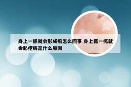 身上一抓就会形成癣怎么回事 身上抓一抓就会起疙瘩是什么原因