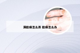 满脸癣怎么弄 脸癣怎么办