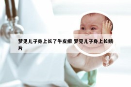 梦见儿子身上长了牛皮癣 梦见儿子身上长鳞片