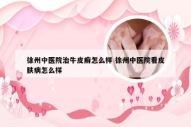 徐州中医院治牛皮癣怎么样 徐州中医院看皮肤病怎么样