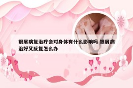 银屑病复治疗会对身体有什么影响吗 银屑病治好又反复怎么办