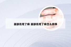 面部出现了癣 面部出现了癣怎么回事