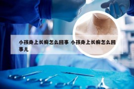 小孩身上长癣怎么回事 小孩身上长癣怎么回事儿