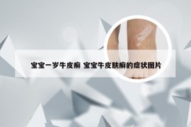 宝宝一岁牛皮癣 宝宝牛皮肤癣的症状图片