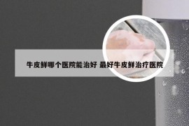 牛皮鲜哪个医院能治好 最好牛皮鲜治疗医院