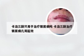 卡泊三醇只用于治疗银屑病吗 卡泊三醇治疗银屑病几周起效