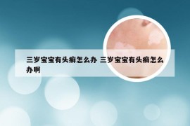 三岁宝宝有头癣怎么办 三岁宝宝有头癣怎么办啊