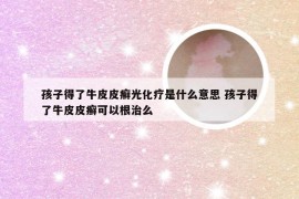 孩子得了牛皮皮癣光化疗是什么意思 孩子得了牛皮皮癣可以根治么