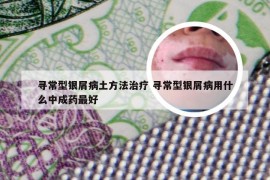 寻常型银屑病土方法治疗 寻常型银屑病用什么中成药最好