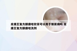 皮康王复方酮康唑软膏可以用于银屑病吗 皮康王复方酮康唑洗剂